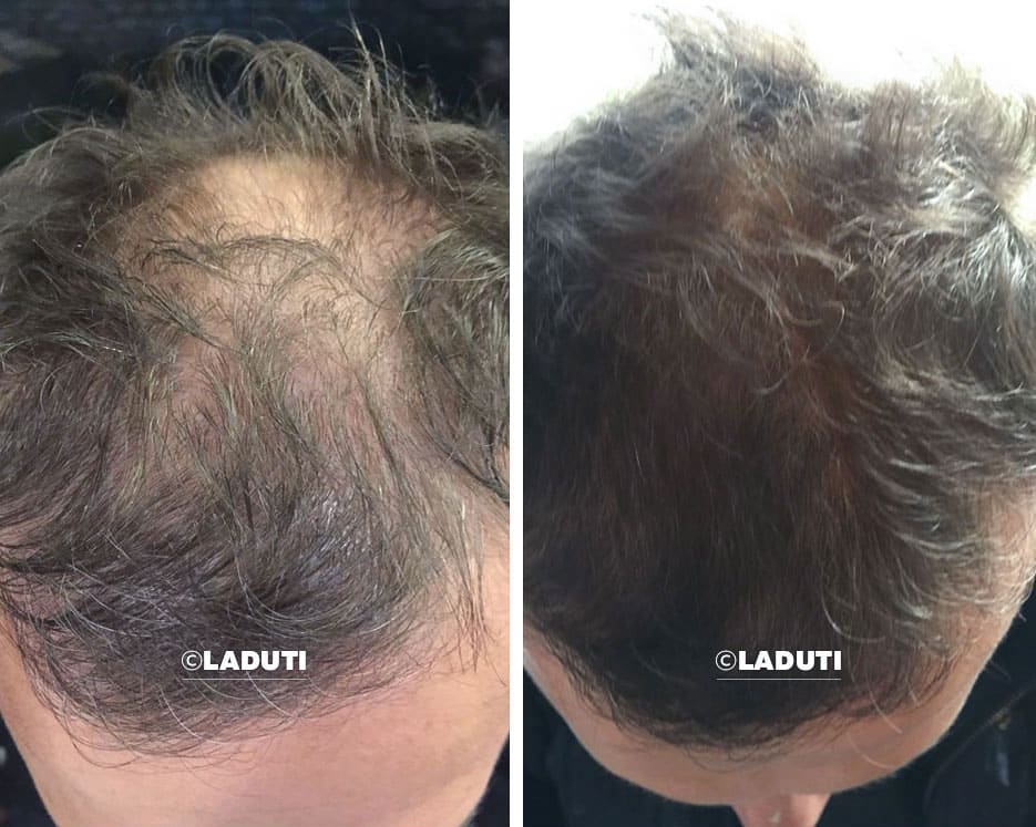 Laduti before and after