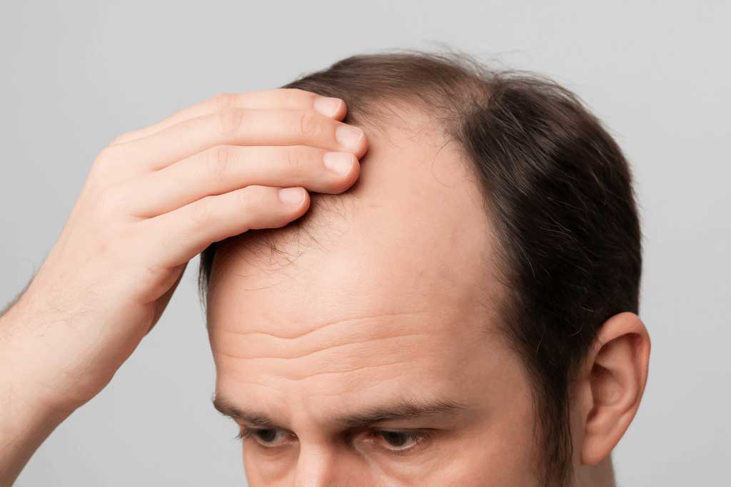 Understanding a receding hairline